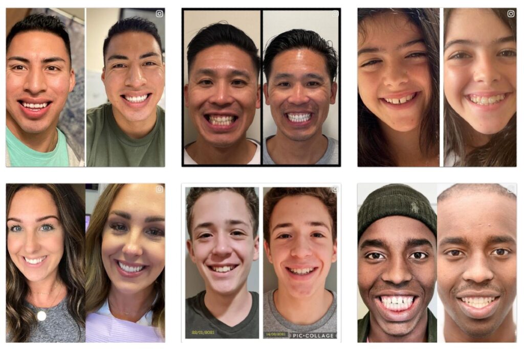Invisalign Before and After images of 6 customers