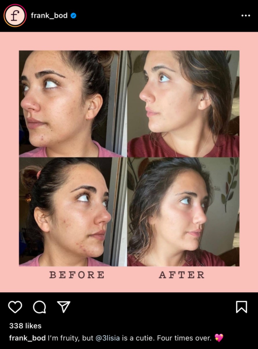 Before and after images of a Frank Body customer's face showing clearer skin